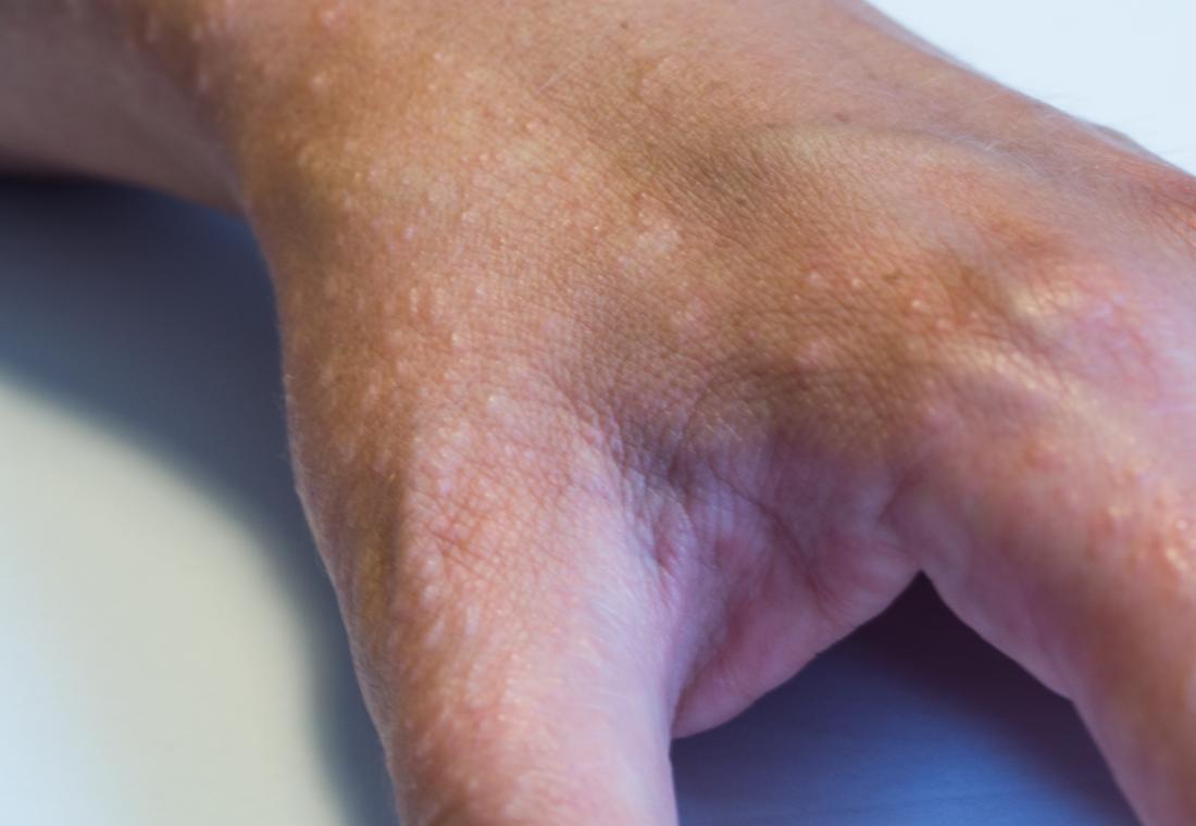 eczema tips soothe itch tricks